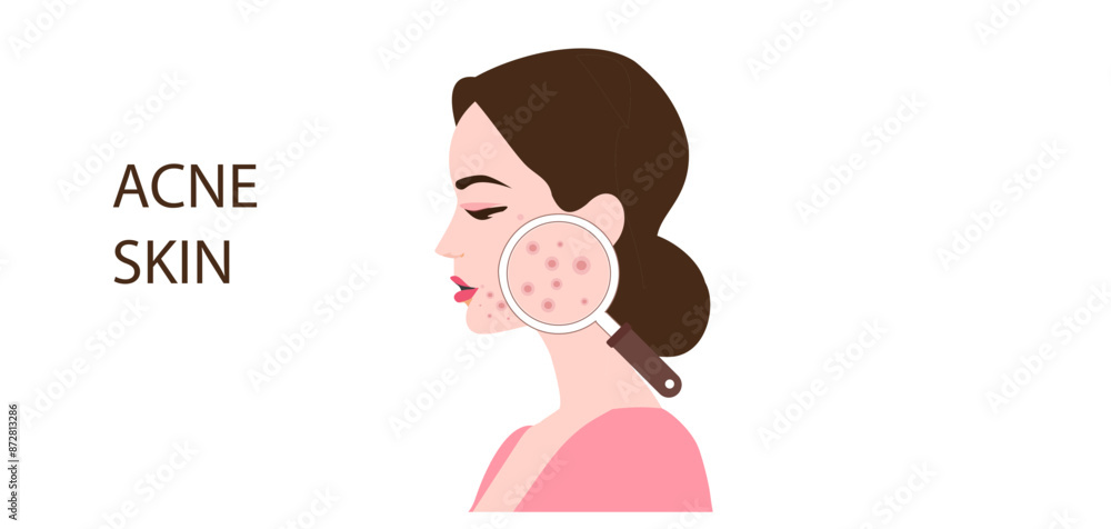 Young woman face with skin acne, pimples, blackheads vector illustration. Acne skin face problem concept Young woman face with skin acne, pimples, blackheads vector illustration. Acne skin face problem concept