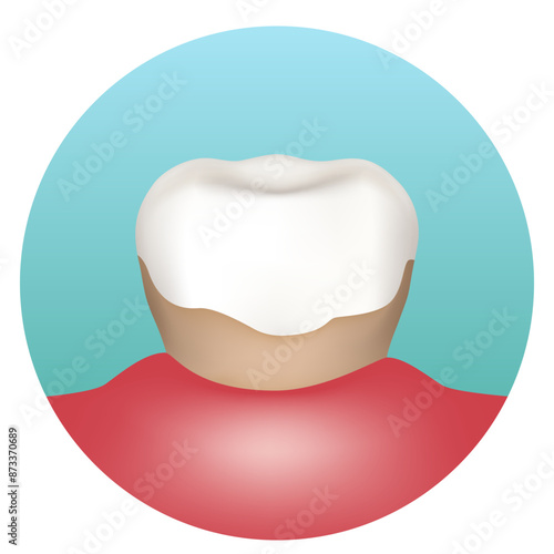 Tartar. Tooth with tartar. Vector illustration.