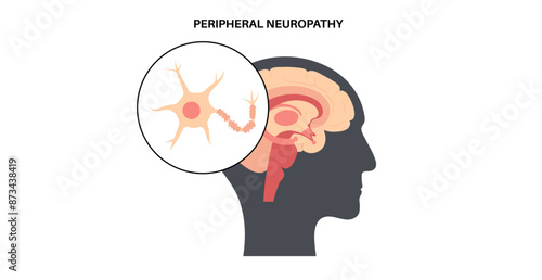 Peripheral neuropathy medical poster