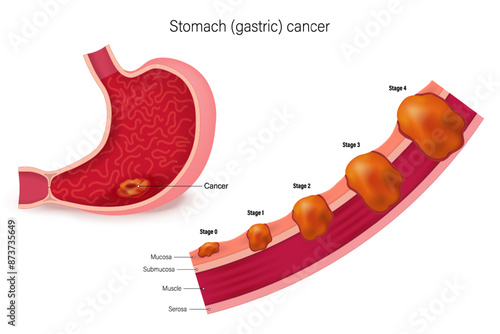 Stages of stomach cancer vector. Stages growth malignant cancerous tumor. Classification of Malignant tumours.