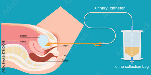 Urinary catheter in the female body with urinary bag.