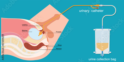 Urinary catheter in the male body with urinary bag.