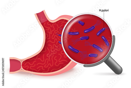 Stomach diseases vector. Helicobacter Pylori in the stomach. Bacterium that causes gastritis. Magnifying glass with bacteria.