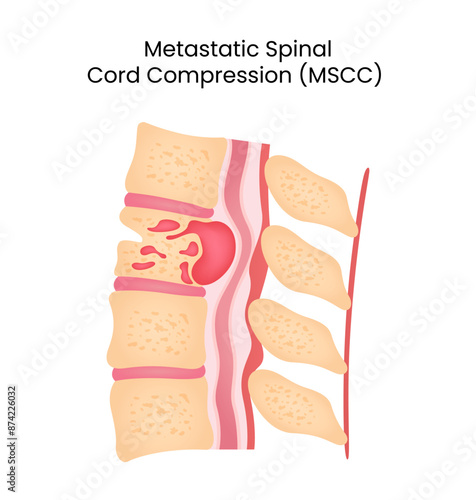 Metastatic Spinal Cord Compression (MSCC)