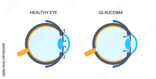 Glaucoma eye disease