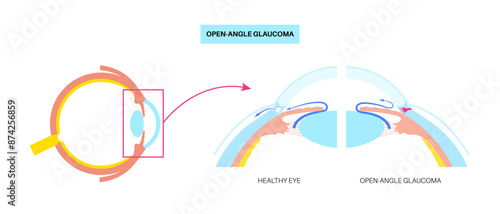 Glaucoma eye disease