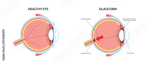 Glaucoma eye disease