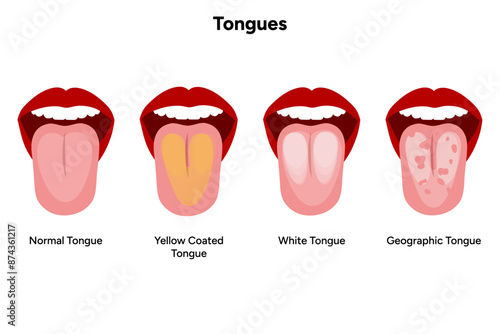 Normal, yellow coated, white, geographic tongue