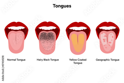 Normal, hairy black, yellow coated, geographic tongue