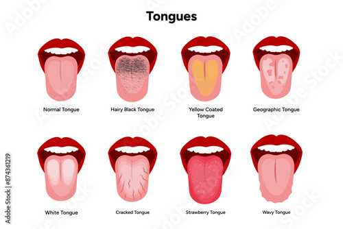 Normal, hairy black, yellow coated, geographic, white, cracked, strawberry, wavy tongues 