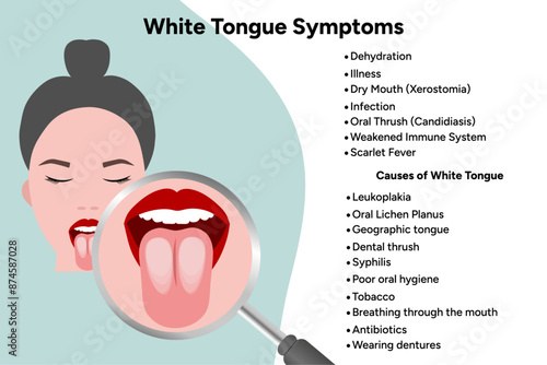 White tongue symptoms, medical information