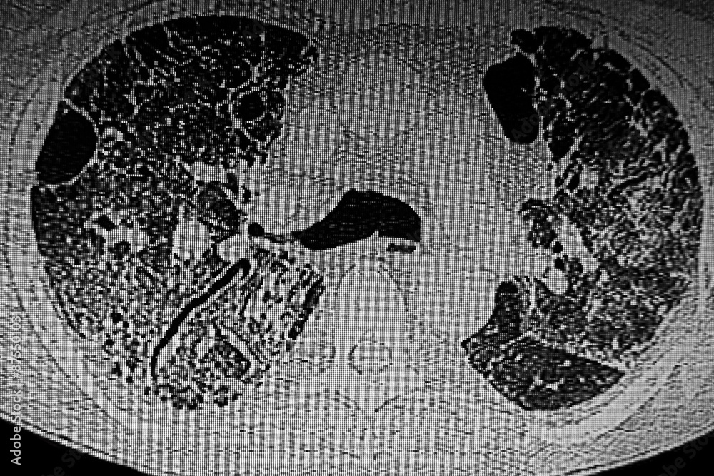 CAT- Scan of interstitial lung disease secondary to scleroderma. Medical themes