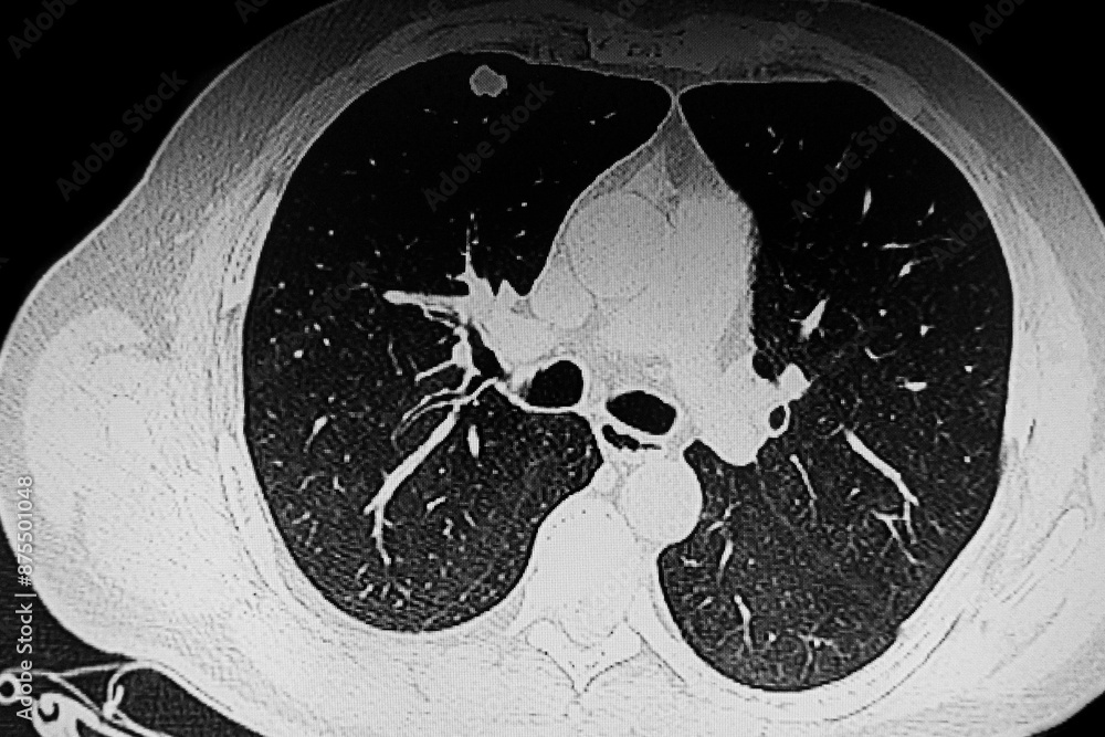 Chest Ct Scan Solid middle lobe nodule