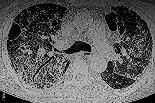 Obraz na płótnie CAT- Scan of interstitial lung disease secondary to scleroderma. Medical themes w salonie