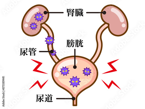 シンプルな膀胱炎の図解イラスト素材