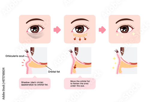 How to remove dark circles under the eyes with Lower blepharoplasty (Transconjunctival blepharoplasty)