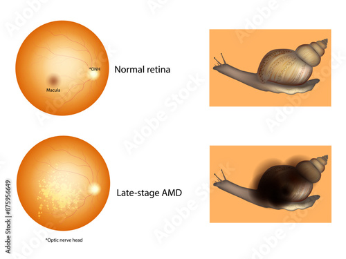 Age-Related Macular Degeneration or AMD. Late-stage AMD and Normal retina. Medical illustration 
