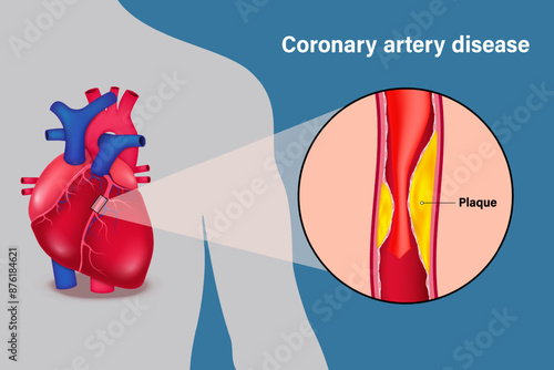 Coronary artery disease vector. Coronary heart disease. CAD that caused by atherosclerosis. Cholesterol in blood vessels. Clogged arteries caused by cholesterol.