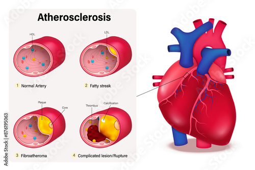 Stages of Atherosclerosis vector. Cardiovascular Disease. Coronary artery syndrome. Clogged artery. Causes of myocardial ischemia. Coronary heart disease.