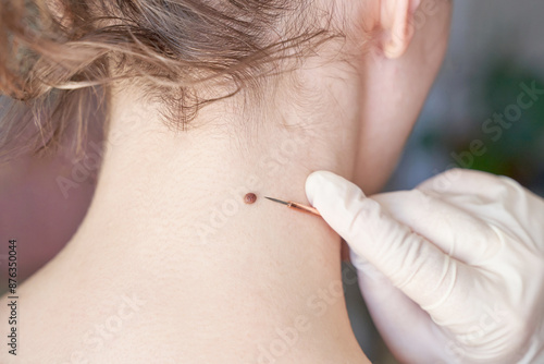 Foto Woman examing her abnormal mole