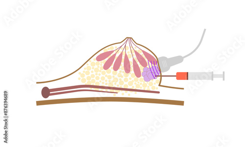 Breast biopsy flat minimal chart. Diagnostic method of female disease.