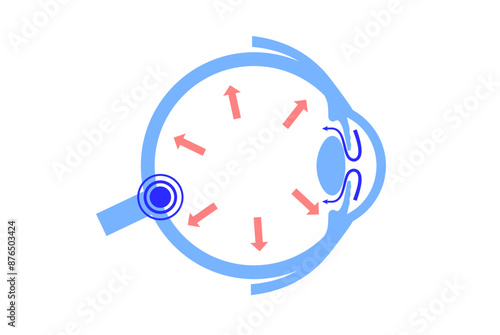 Glaucoma eye pressure