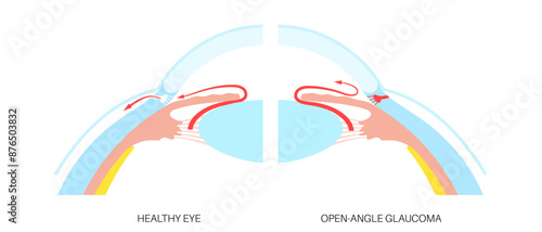 Glaucoma eye disease