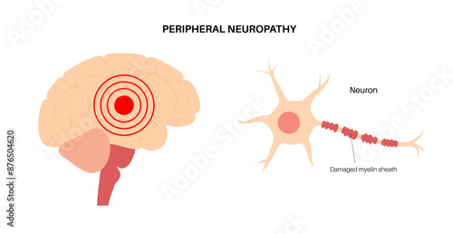 Peripheral neuropathy medical poster