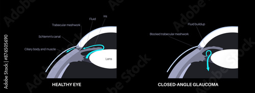 Glaucoma eye disease
