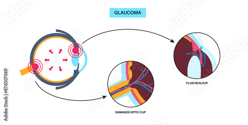 Glaucoma eye disease