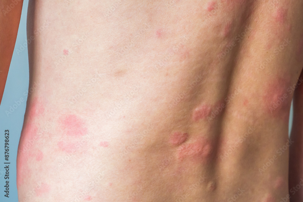 Young asian man itching and scratching on his back from allergic itchy dry skin eczema dermatitis insect bites Young asian man itching and scratching on his back from allergic itchy dry skin eczema dermatitis insect bites