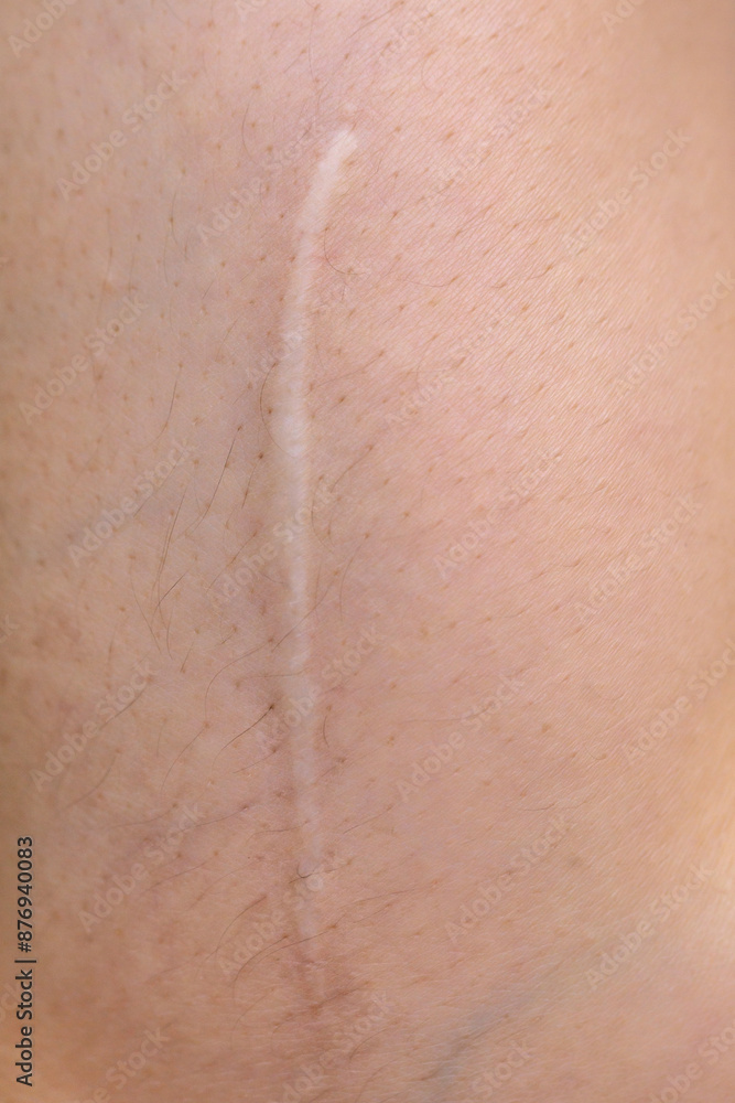 Fototapeta premium Close up of cyanotic keloid scar caused by surgery and suturing