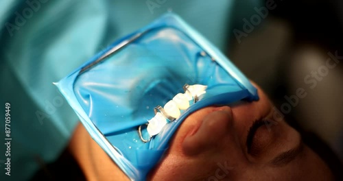 Dentist processes teeth of female patient with airstream to get rid of saliva. Specialist installs veneers on natural teeth of client slow motion photo