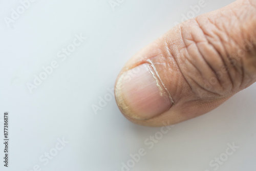 Photos Finger nails infected with fungus Image of the concept of health care with illne