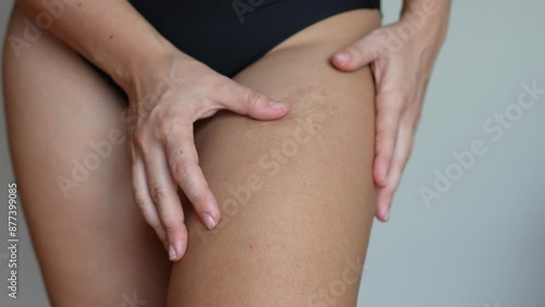 Wallpaper Mural Cropped shot of a young woman touching a burn scar on her thigh on a gray background. Skin problem. Cosmetology, beauty concept Torontodigital.ca