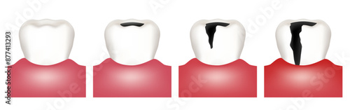 Stages of caries development. Vector illustration.