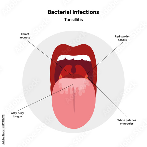 Viral bacterial infection, sore throat, tonsillitis medical diagram  photo