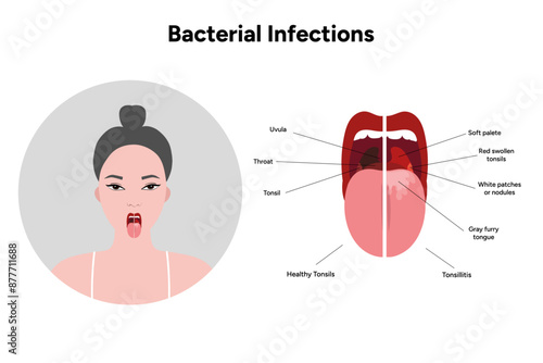 Woman with open mouth, viral bacterial infection, sore throat, tonsillitis, and healthy tonsils medical diagram 