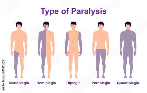 Paralysis types, spinal cord injury. Stroke, tumor, nerve damage brain. Face palsy.