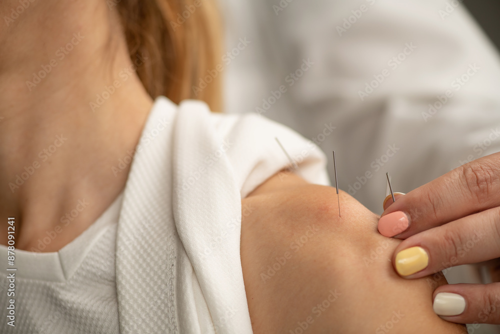 Acupuncture Treatment for Shoulder Pain and Rotator Cuff Injuries Acupuncture Treatment for Shoulder Pain and Rotator Cuff Injuries