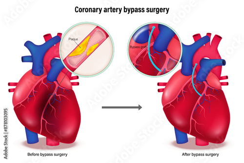 Coronary artery bypass surgery. Heart muscle damaged by blockage of the coronary arteries and the heart after bypass surgery.