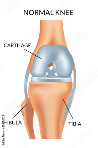 Knee arthrosis. Healthy knee structure. Bone exposure, healthy knee structure comparison. Medical poster with foot bones. Isolated vector illustration