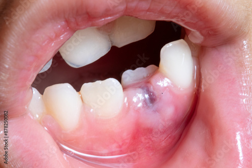 close-up of inflamed gums with dental abscess and tooth decay photo