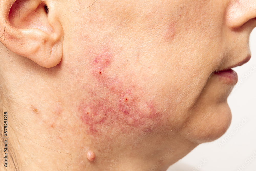 close-up of woman's face showing skin condition with redness and pimples close-up of woman's face showing skin condition with redness and pimples