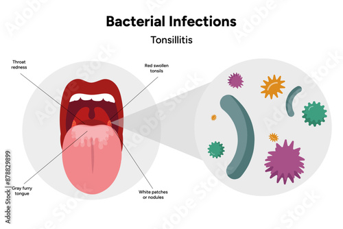 Bacterial infection tonsillitis 