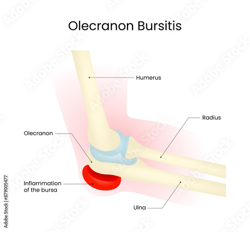 Olecranon Bursitis Inflammation of Bursa