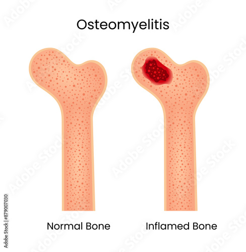 Osteomyelitis of Normal Bone and Inflamed Bone