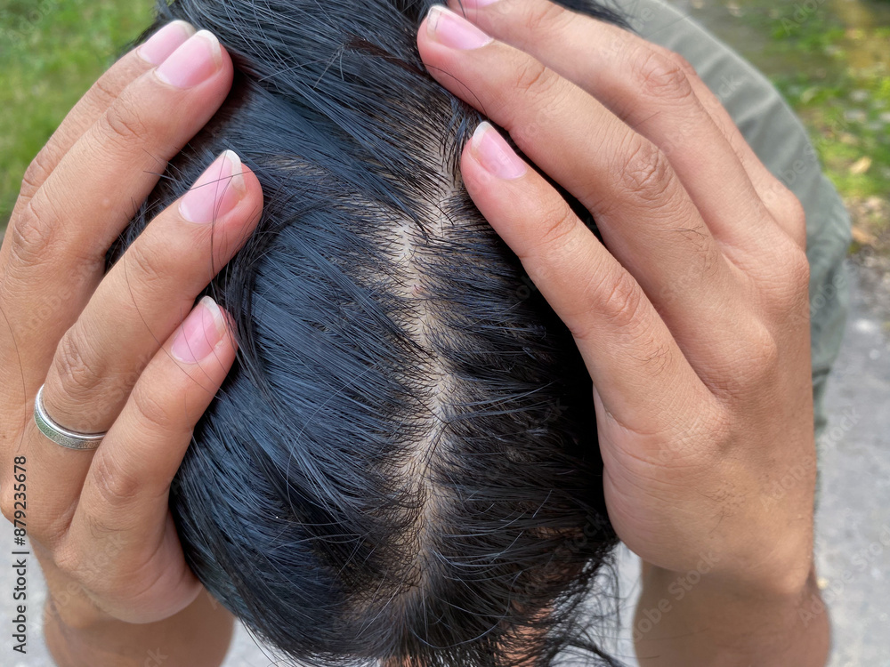 Naklejka premium man have a dandruff and hair loss