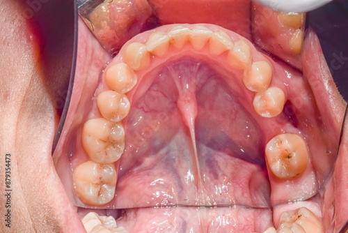 Occlusal view of a mandible arch, tongue retracted, saliva shining reflecting lights on sublingual floor, healthy teeth. Indirect view with dental mirror, lips retracted with plastic cheek retractor. photo