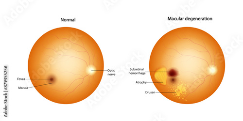 Normal retina and Macular degeneration: Drusen, Atrophy, Subretinal hemorrhage. 